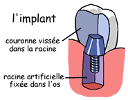 implant