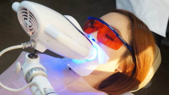 Blanchiment dentaire au laser