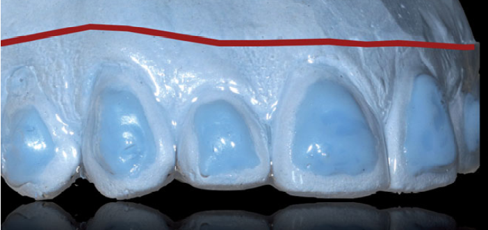 Nocivité des techniques d’éclaircissement sur dentsvitales entre mythes et réalités